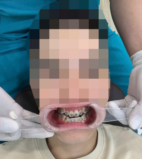Trầm cảm vì niềng răng 3 năm vẫn "hỏ như ngày đầu"- Ảnh 2.