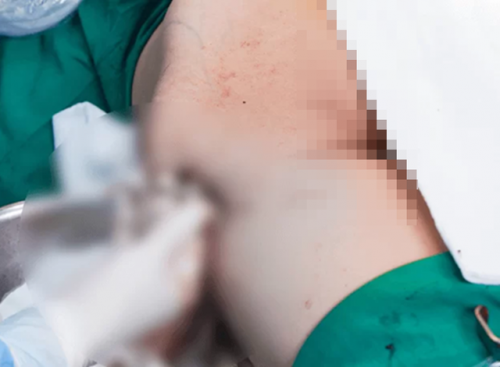 Tiêm 1.000ml filler vào môi